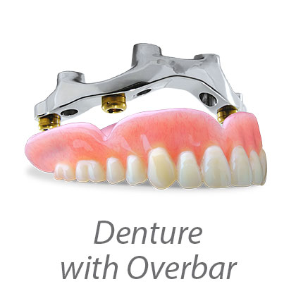 Denture With Overbar