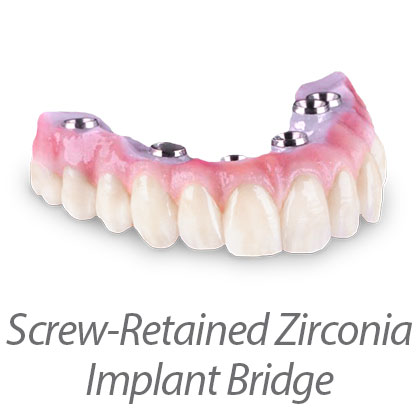 Screw Retained Zirconia Hybrid Bridge