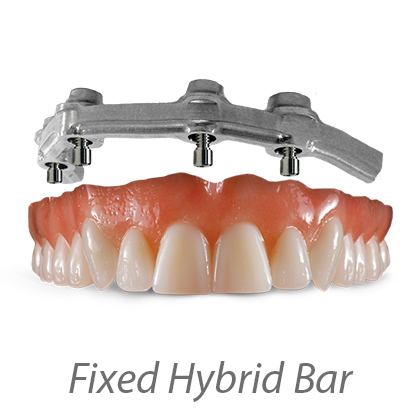 Denture With Overbar