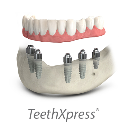 Denture With Overbar
