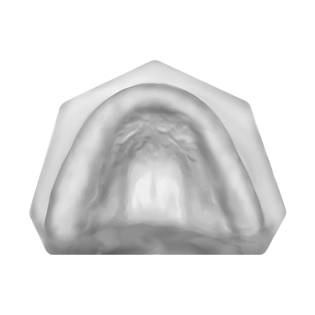 Patient Removable Implant Bridge