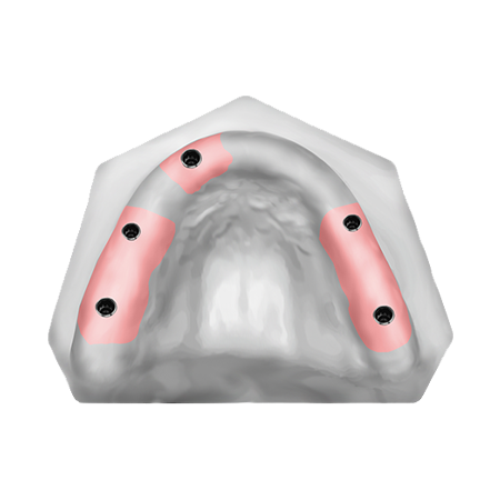 Patient Removable Implant Bridge