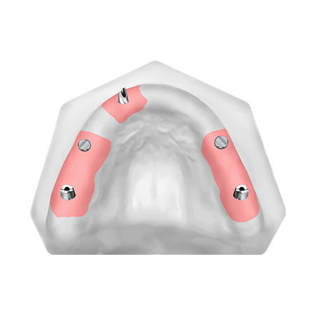 Patient Removable Implant Bridge