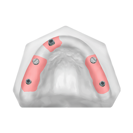 Patient Removable Implant Bridge