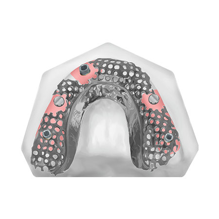 Patient Removable Implant Bridge