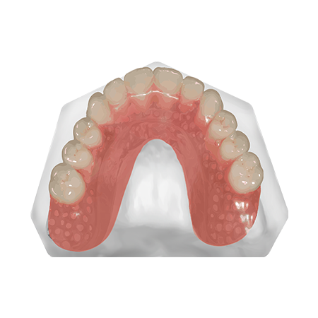 Patient Removable Implant Bridge