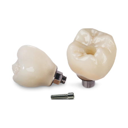 Screw-Retained Crowns