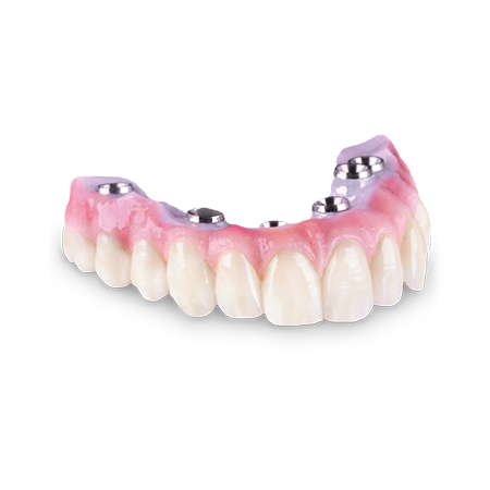 Screw-Retained Zirconia Implant Bridge